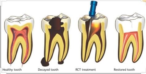Rct Procedure